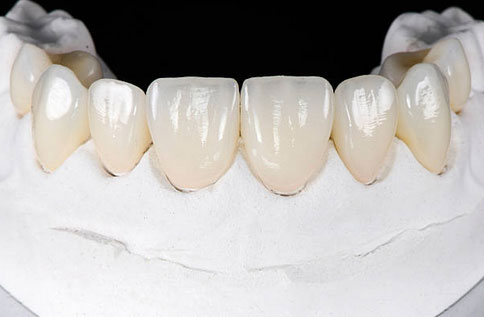 Dental Veneers Tucson, AZ - Old Pueblo Dental